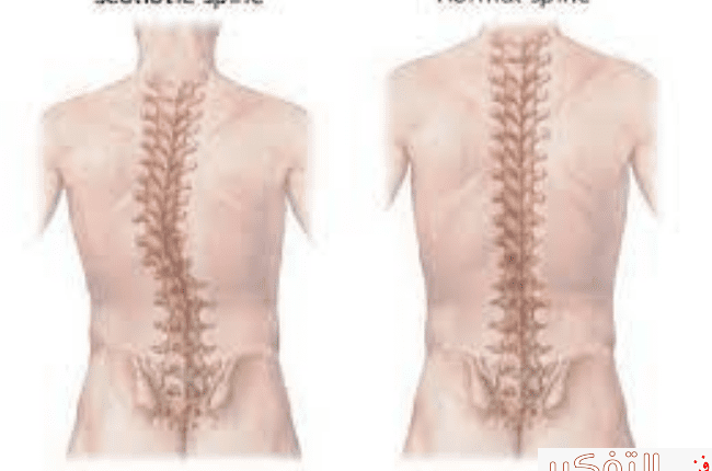 الاتب ولماذا يحدث وما هو أسبابه وعلاجه